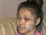 Kyaw was slashed by two girls whom she knows because her ex-boyfriend also used to date one of the attackers.