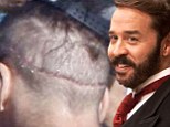 Photos of a scar on the back of Jeremy Piven's head point to a hair transplant