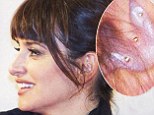 Alternative: Penelope Cruz was last night spotted with acupuncture needles in her ear - a sign that she is undergoing auriculotherapy